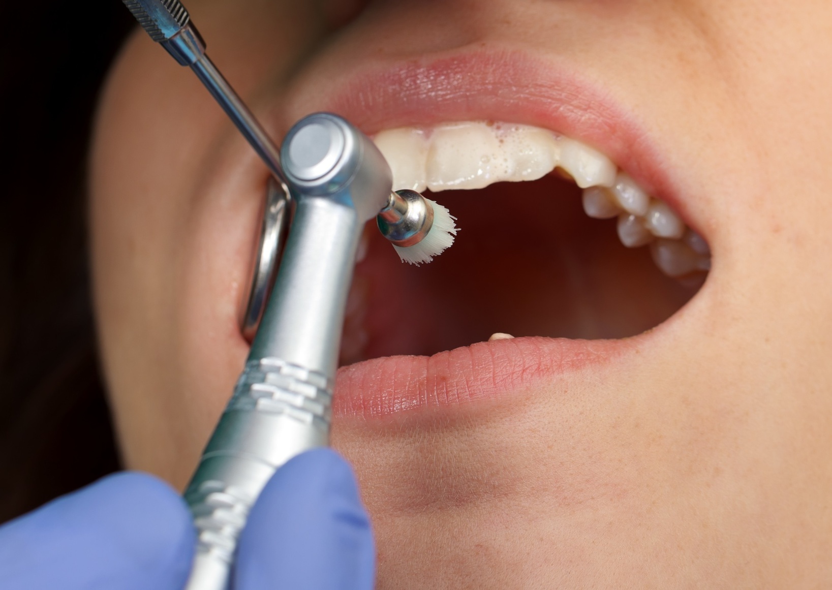 4.虫歯・歯周病の治療